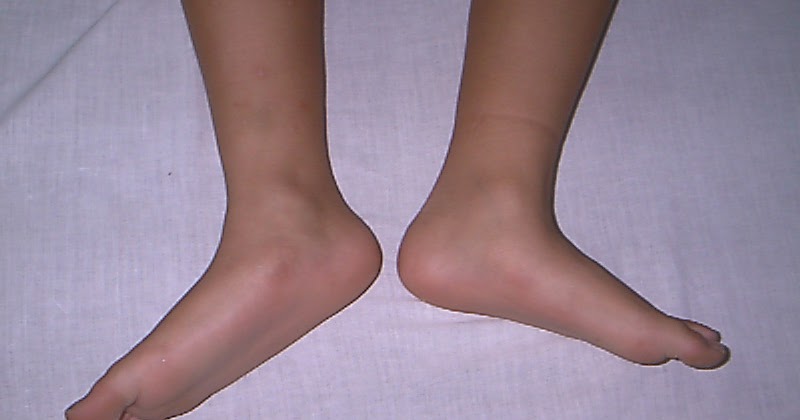 tratamentul artrozei piciorului 2 grade