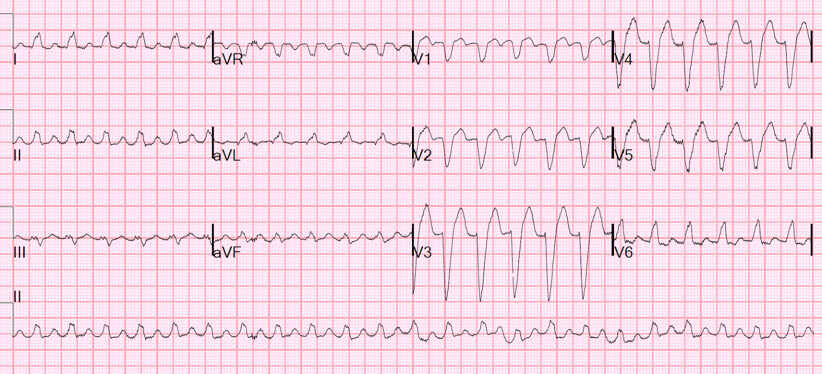 Dr. Smith's ECG Blog Cardiogenic shock with wide complex tachycardia