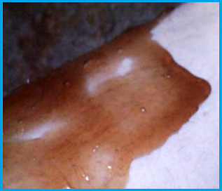 uneven sugaring paste application
