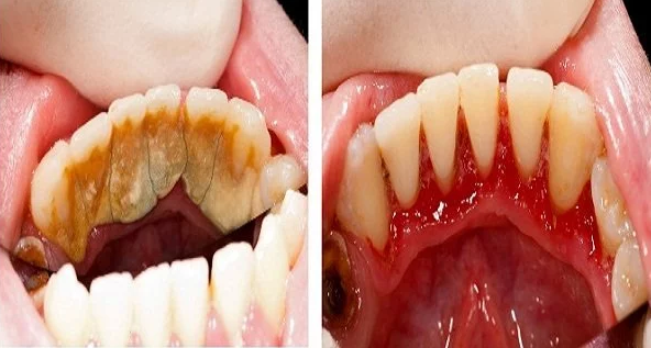 Be Your Own Dentist! Here Is The Technique To Remove Tartar Buildup At Home