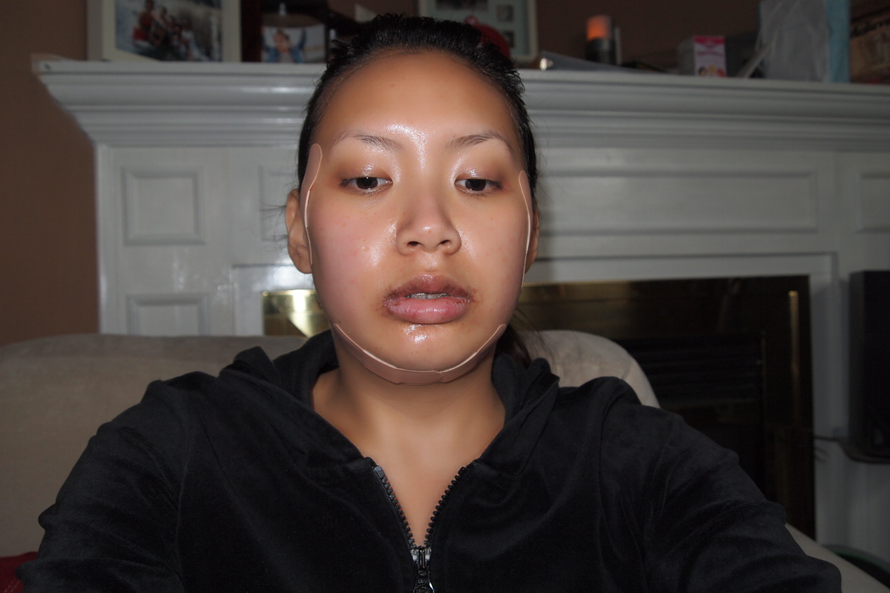 Kat Marie's Jaw Surgery Blog postsurgery day 1, 2, & 3 (they say the