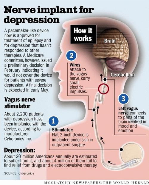 Mel’s Candid Commentary of Life Epilepsy and Depression