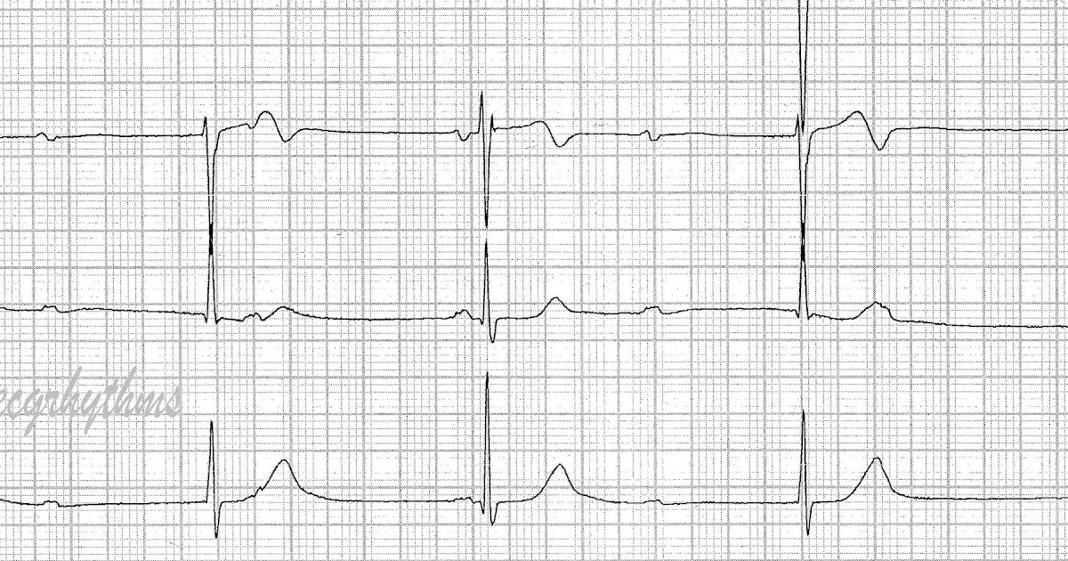 ECG Rhythms Advanced Heart Block