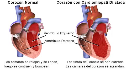 miocardiopatia