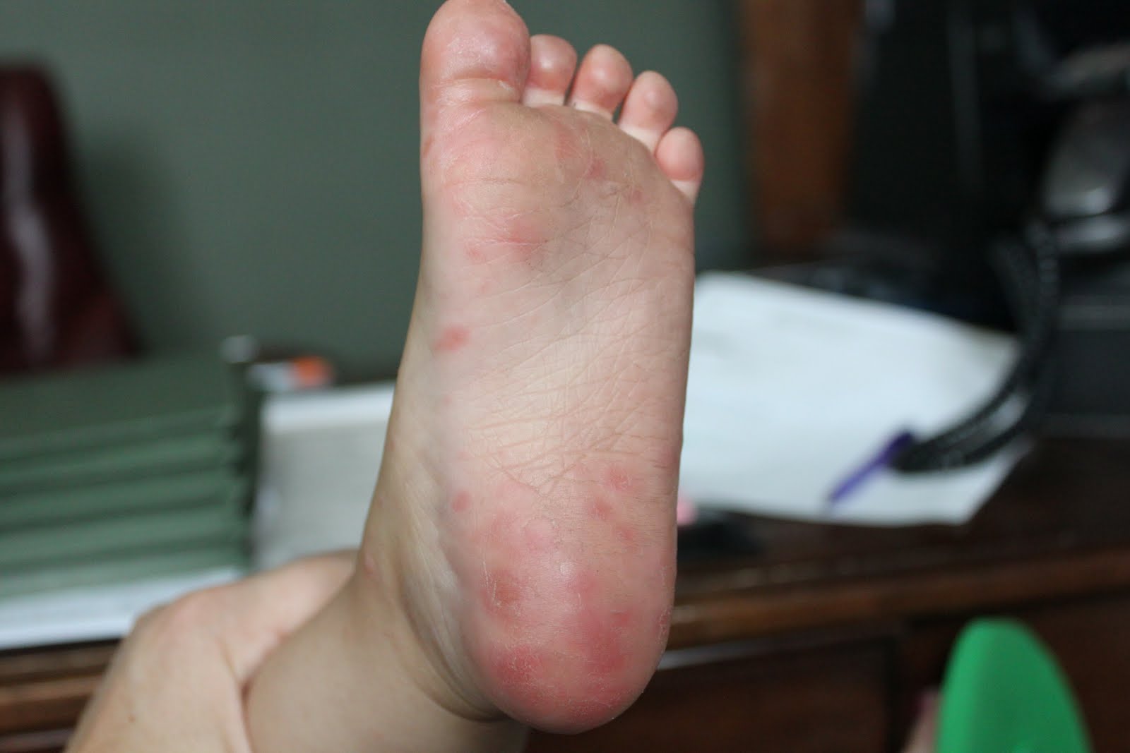 bubbles-fun-hand-foot-mouth-disease-strep-throat