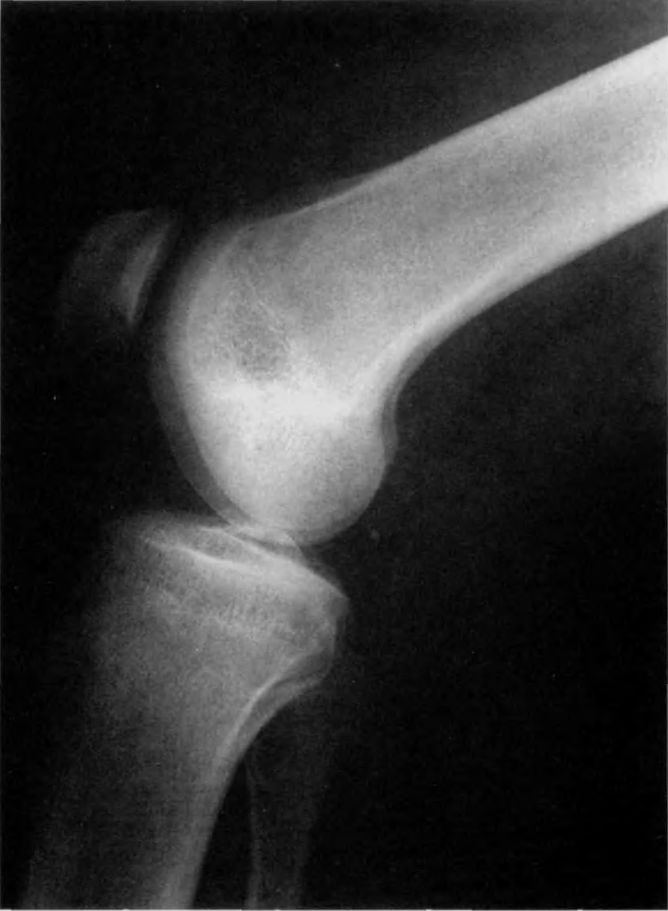 Хондромаляция мыщелка. Остеохондральный перелом надколенника. Хондромаляция коленного сустава рентген. Хондромаляция надколенника рентген. Остеомаляция надколенника.