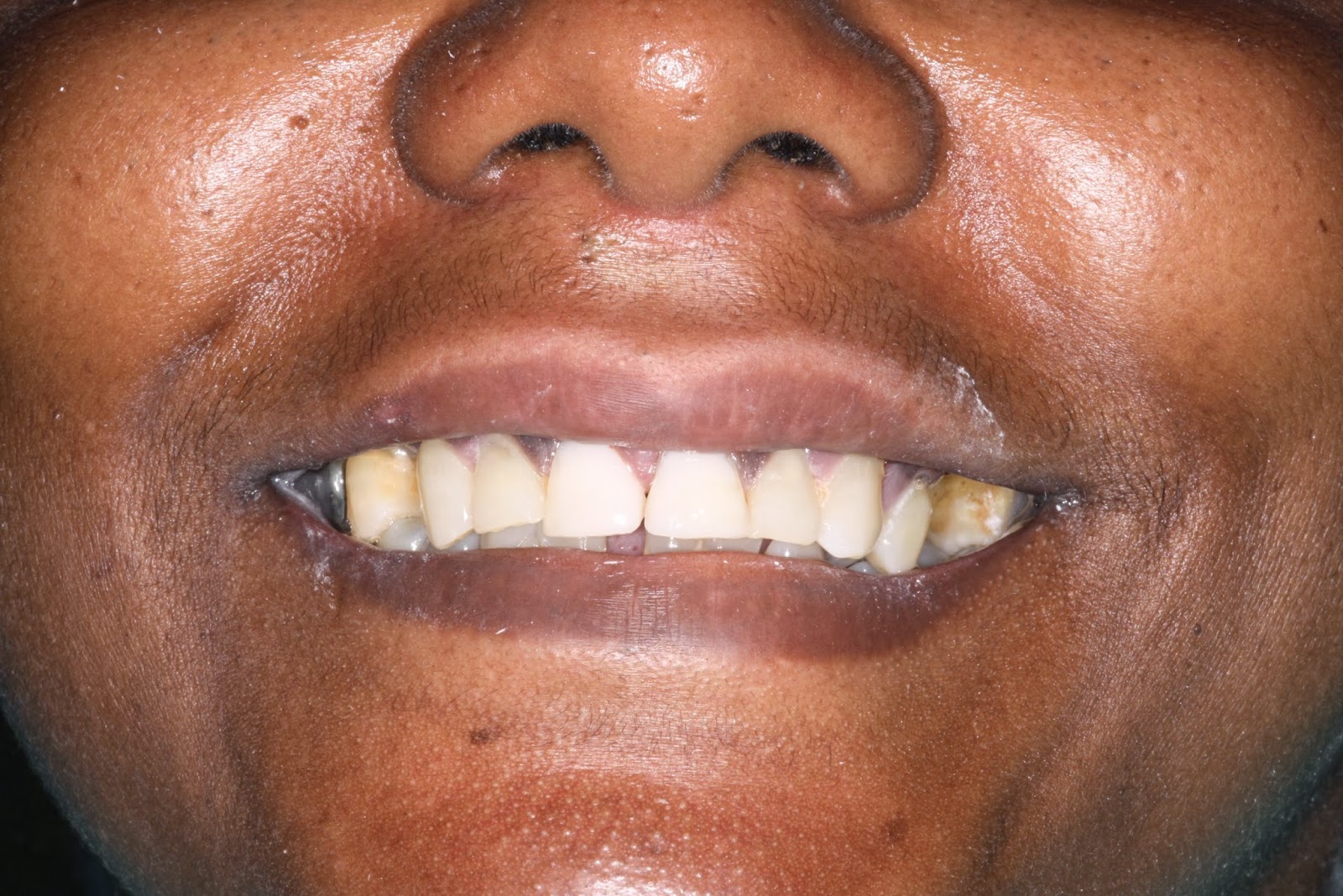 Crescent Dental on Blogspot! Extreme Acid Tooth Erosion Due to Lemon
