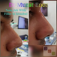 5 Minutes Nose Job With Filler in Istanbul