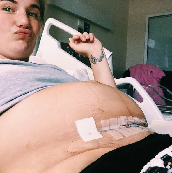 This Mom Wants Everyone To Know The Truth About The Women Who Have Had A Caesarean Section