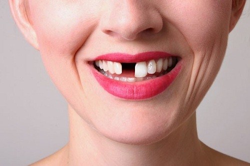 LƯU Ý CỰC KỲ QUAN TRỌNG BẠN CẦN NẮM RÕ KHI CẤY GHÉP IMPLANT -3