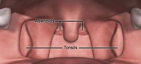 Enlarge adenoids and Homeopathy treatment