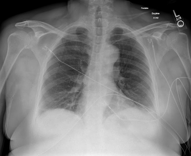 Dr. Smith's ECG Blog A Woman with 8 hours of Ongoing Crushing Chest