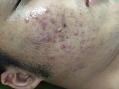 Mụn trứng cá là gì?