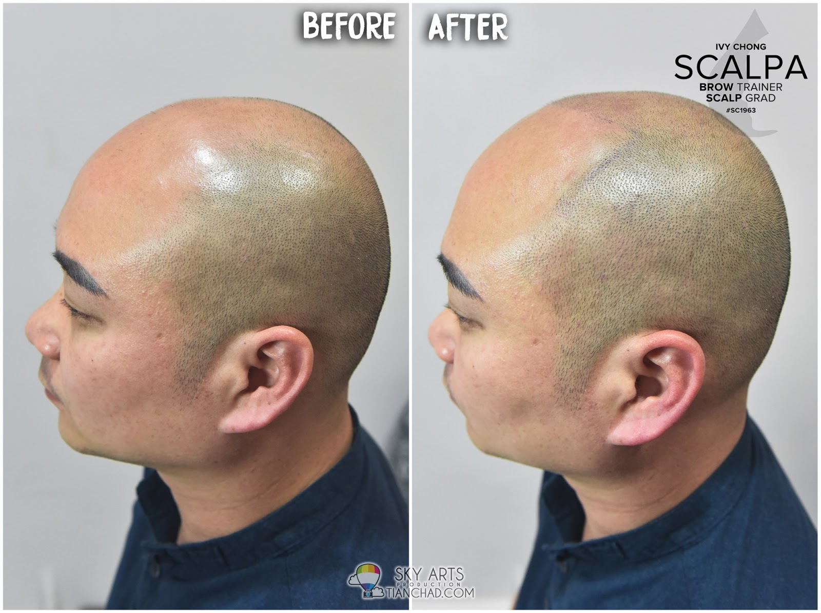Best Scalp Micropigmentation Smp In Malaysia Smp 让你不再为