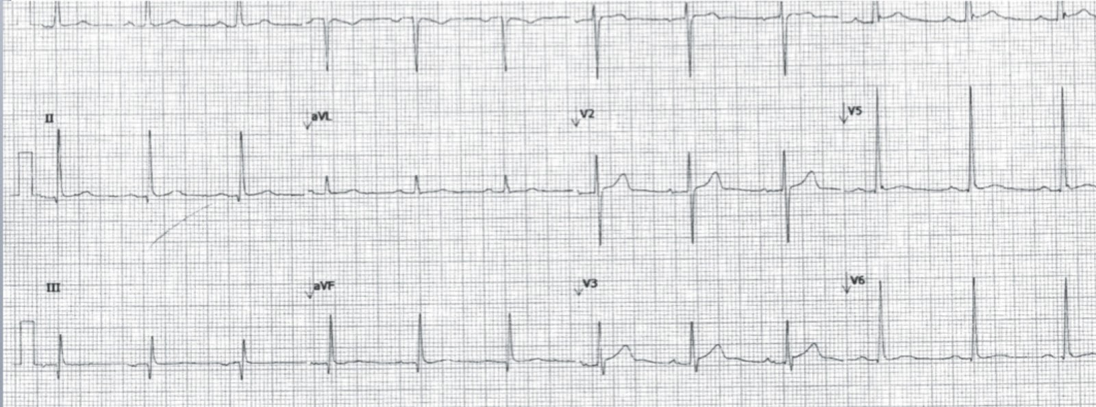 Dr. Smith's ECG Blog Best Explanation of Terminal QRS Distortion in