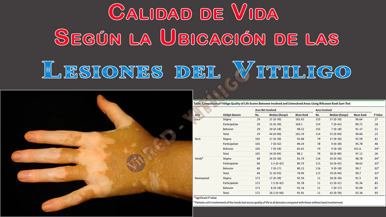 Calidad de Vida Según la Ubicación de las Lesiones del Vitiligo