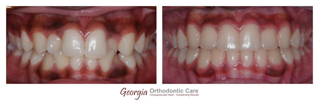 Orthodontic Treatment of Anterior Dental Crossbite, Georgia Orthodontic Care, Lawrenceville & Norcross, Georgia