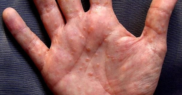 I Have A Rash And Blisters On The Palms Of My Hands And Feet 60