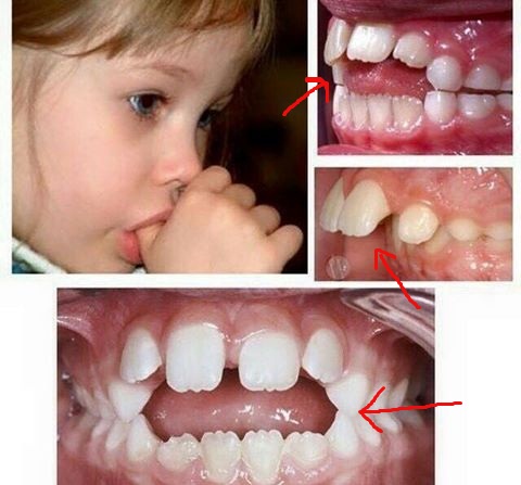 LHKJ Kit De Traitement Des Doigts Pour Bébé De 1 à 5 Ans Pour