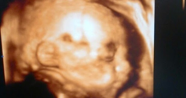 Namee Roslan: 2nd pregnancy : Kenapa Perlu Ceaser Jugak