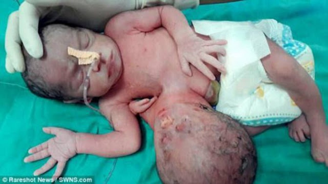 Kepala Bayi Kedua Tumbuh Diperut, Tak Disangka Saat Di Bedah Yang Terjadi Mengejutkan!  Kepala Bayi Kedua Tumbuh Diperut, Tak Disangka Saat Di Bedah Yang Terjadi Mengejutkan!