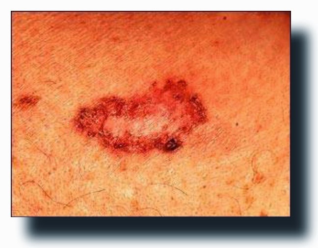 Basal Cell Carcinoma Hand