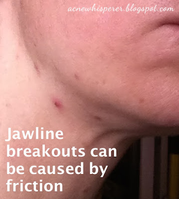 Friction and pressure from scarves and coat collars can aggravate adult acne breakouts along the jawline and neck. 