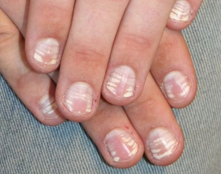What causes white spots on nails and how to manage them? - Dr. Amee Daxini  - YouTube