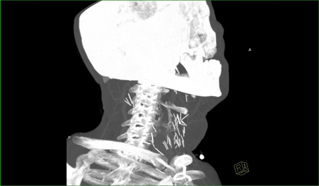 Deformutilation XRay Reveals Needles in the Neck