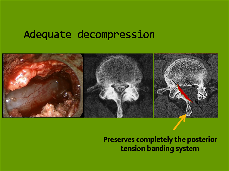 Orthopaedic Surgeon KPJ Ipoh Basic of Spine Endoscopic Surgery
