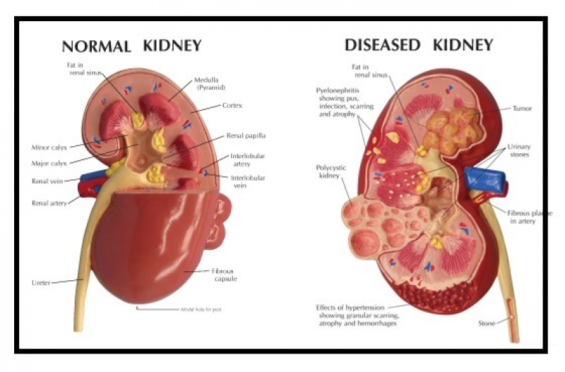 Chronic Kidney Diseases: Mycotoxin-Induced Chronic Kidney ...