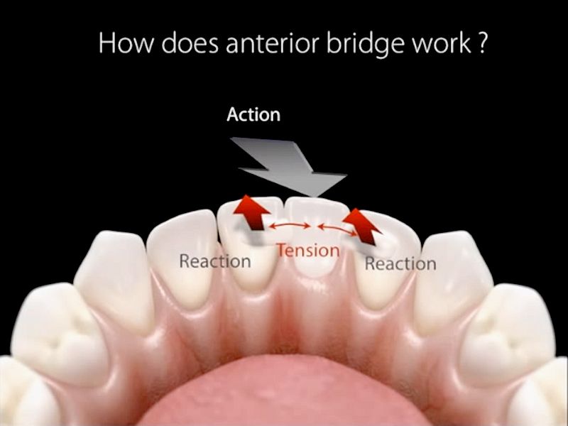 DENTAPREG Anterior Bridge step by step