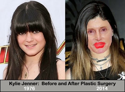 Kylie Jenner before after plastic surgery