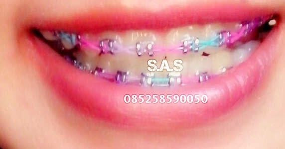 36 Warna Karet Behel Keramik Yang Bagus