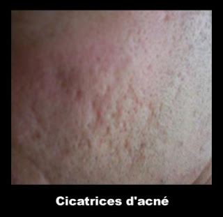 cicatrice acné