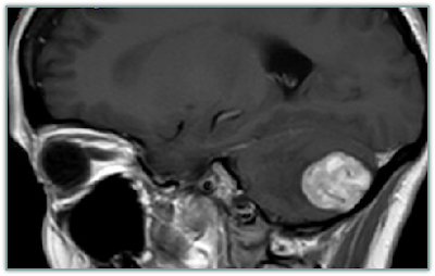 Hemangioblastoma in Cerebellum