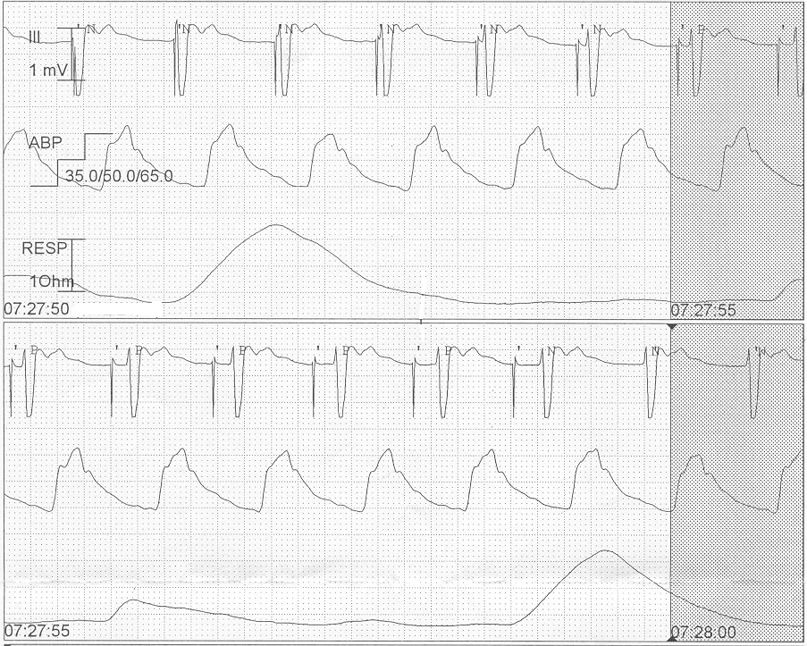 Pedi cardiology Quiz Temporary Pacemaker