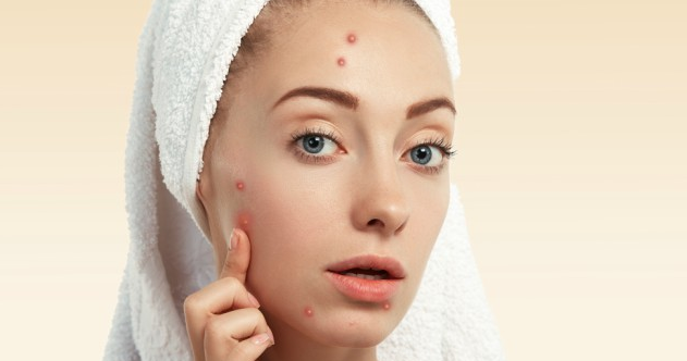 Appearing Acne on Faces? Know the Cause and How to Take Care of the Face if Acne appears Appearing Acne on Faces? Know the Cause and How to Take Care of the Face if Acne appears