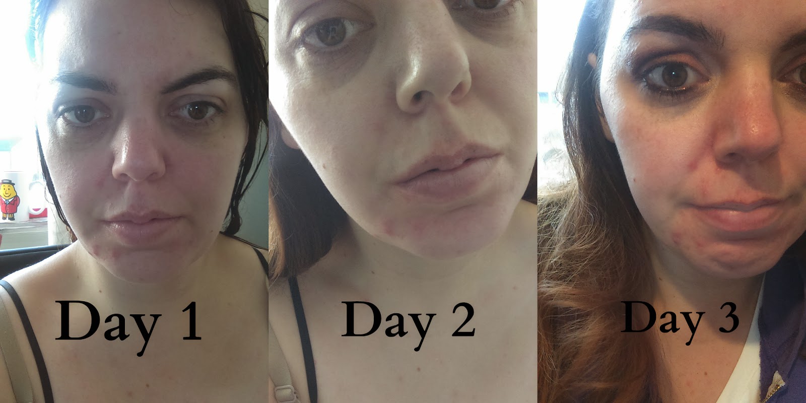 My Acne Story LUSH Grease Lightning