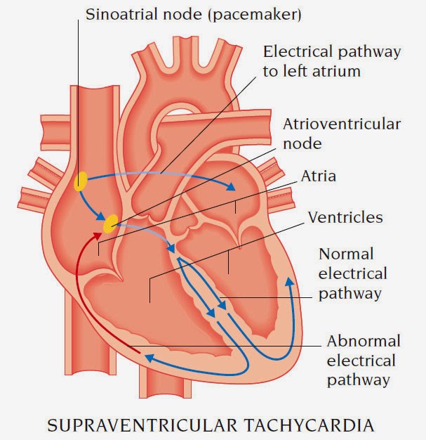 heart arrhythmia heart arrhythmia