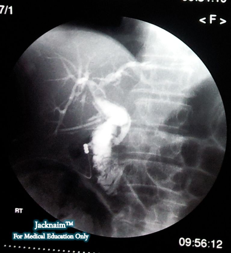 Cholangiogram