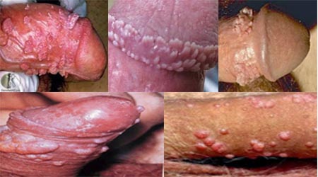 Obat Membunuh Virus Hpv