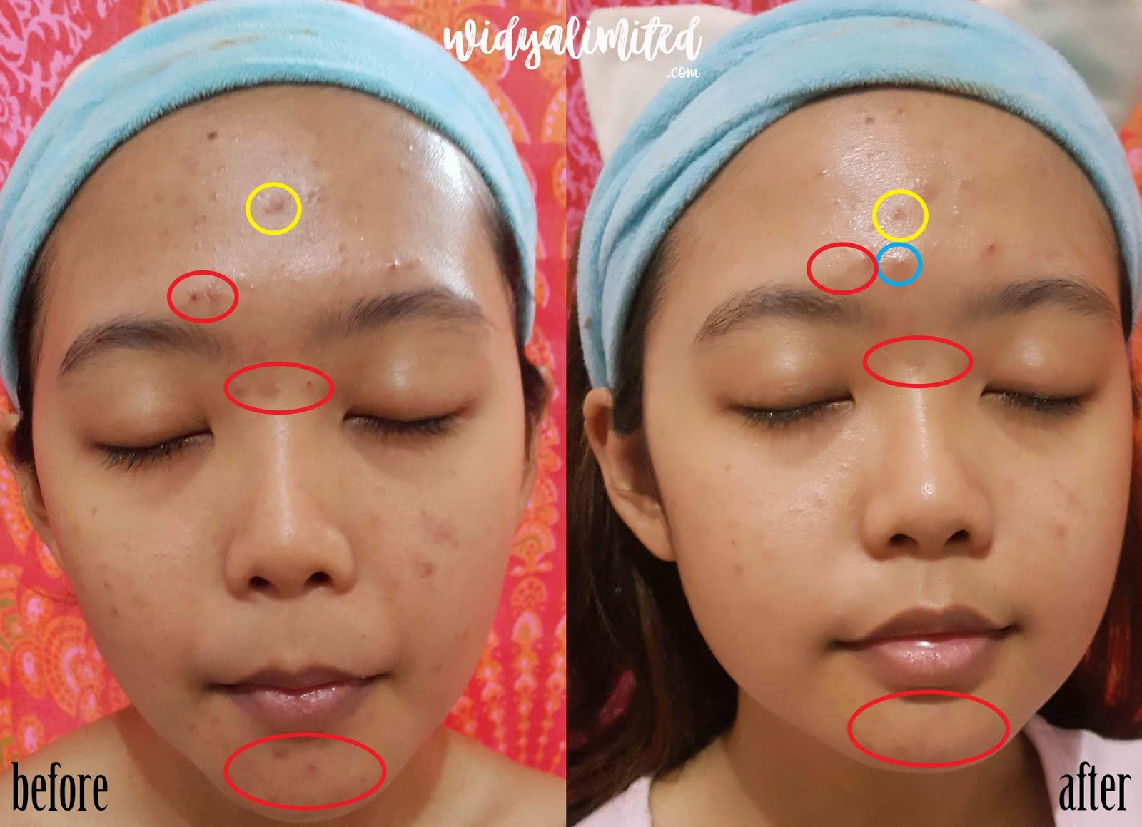 Honest Review Suplemen H2 Pure Skin Bisa Menyembuhkan Jerawat Bahasa Indonesia Widyalimited