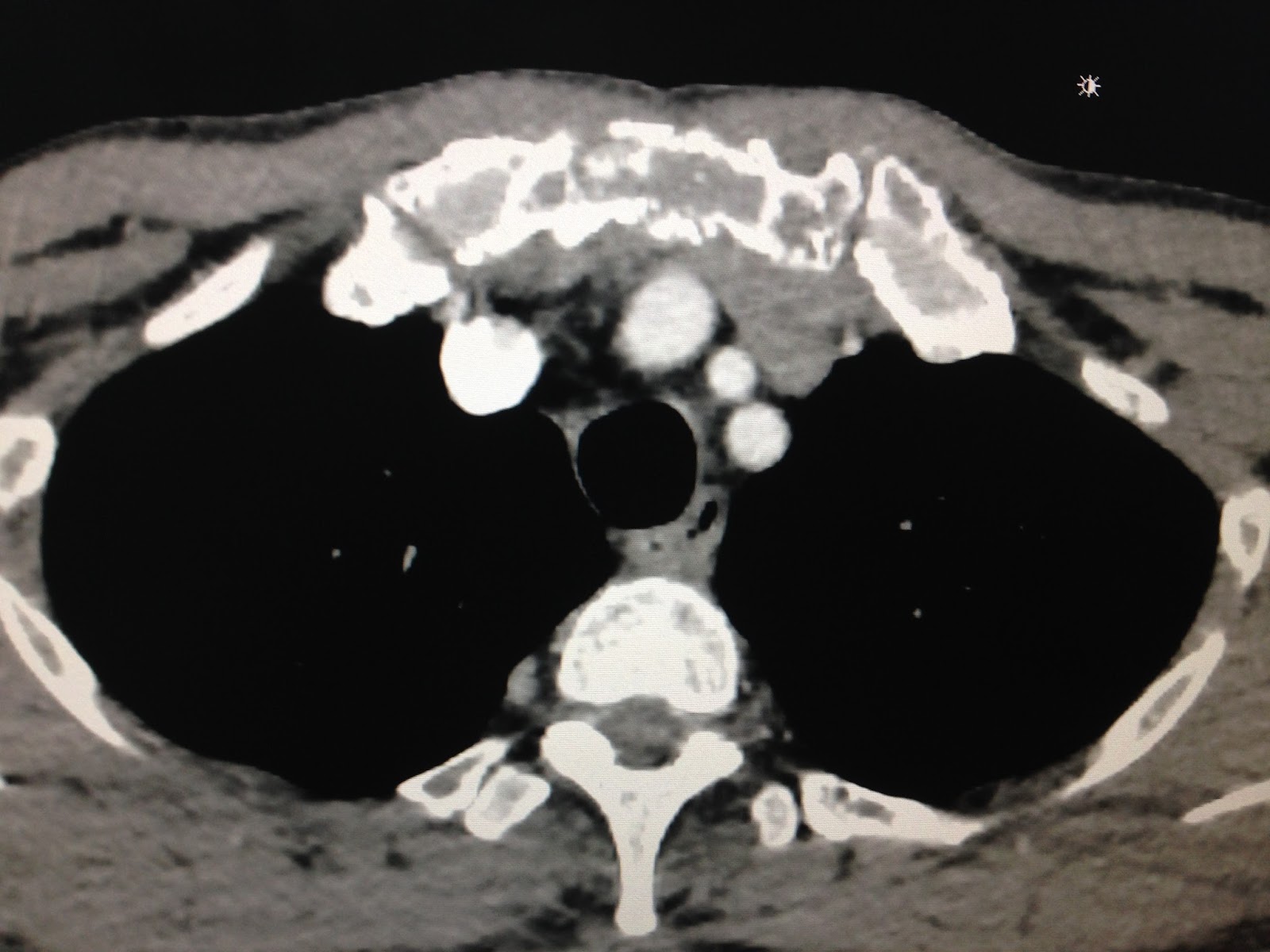 VIETNAMESE MEDIC ULTRASOUND CASE 418 CHEST PAIN in KAHLER DISEASE, Dr