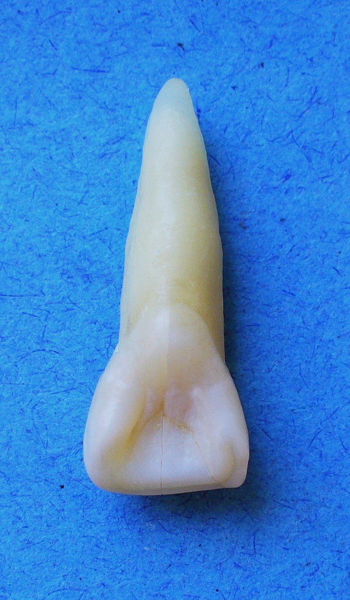 Anatomia Dental CARA LINGUAL DEL INCISIVO CENTRAL SUPERIOR Anatomia Dental CARA LINGUAL DEL INCISIVO CENTRAL SUPERIOR