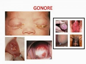 obat alami gonore dari dokter, obat gonore aman untuk ibu hamil, obat tradisional menyembuhkan gonore