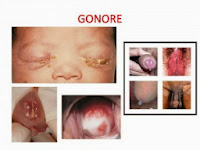 obat alami gonore dari dokter