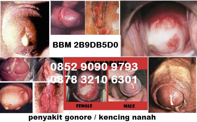 Bahaya Kencing Nanah Pada Pria Bahaya Kencing Nanah Pada Pria