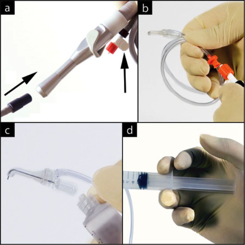EndoVac Uso clínico do método de Irrigação em Endodontia.