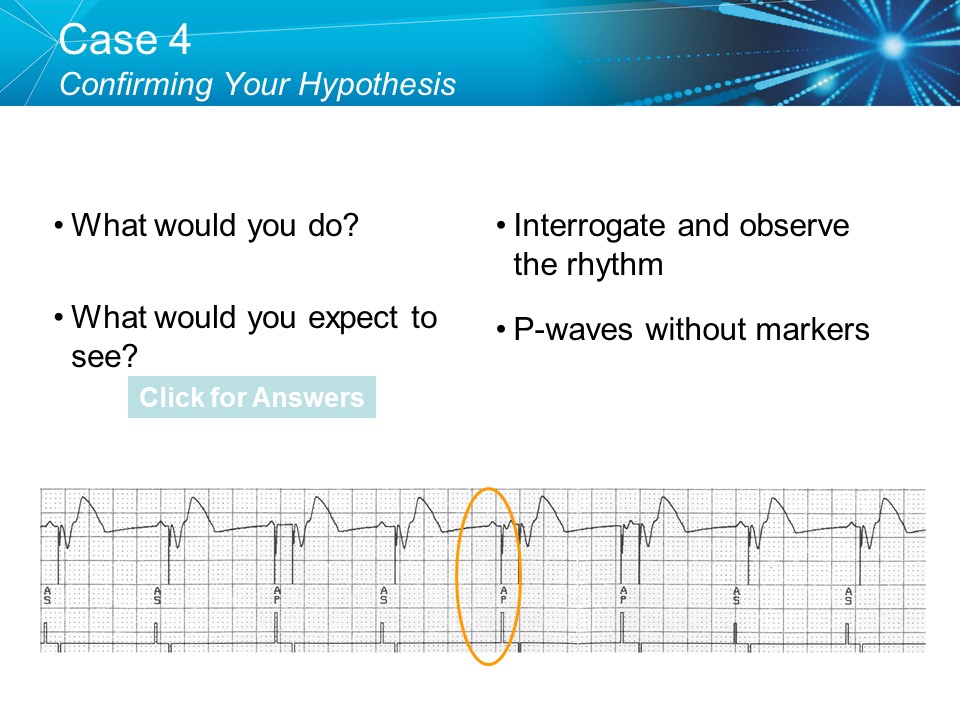 CVT Mohd Farid: Basic Pacemaker Troubleshooting Part I-Medtronic Academy